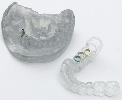 Прототипы зубных коронок, напечатанные на 3D принтере